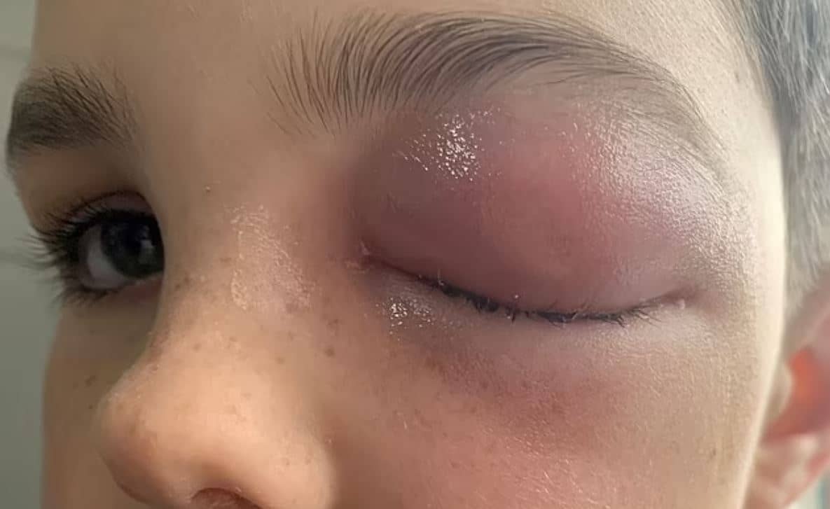 COVID-eye