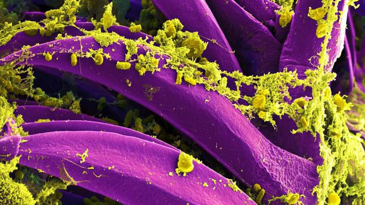 bubonic plague