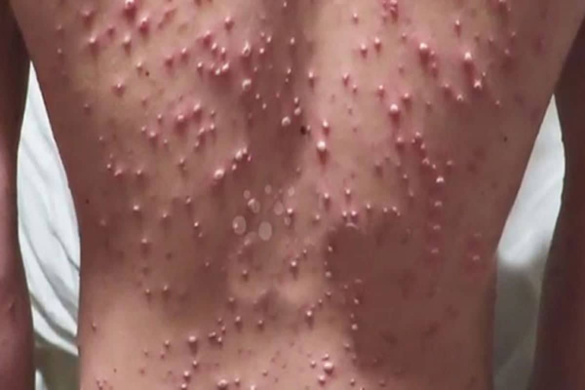 POX