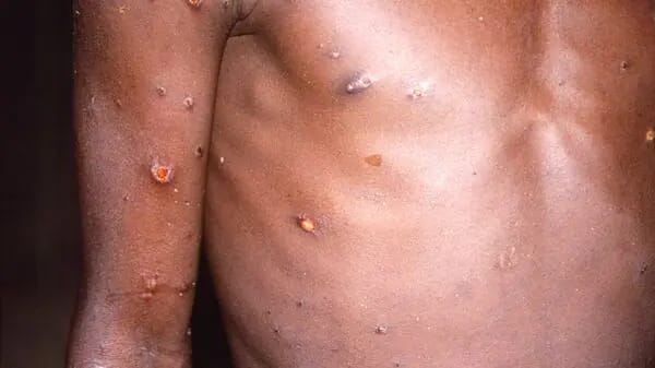 HEALTH-MONKEYPOX--0_1653058666954_1653058679424