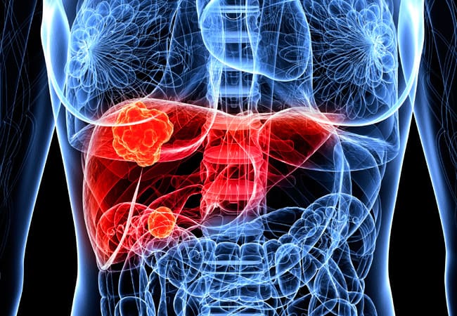 16-DDI-160-LiverTumorClinic-CQD-650x450