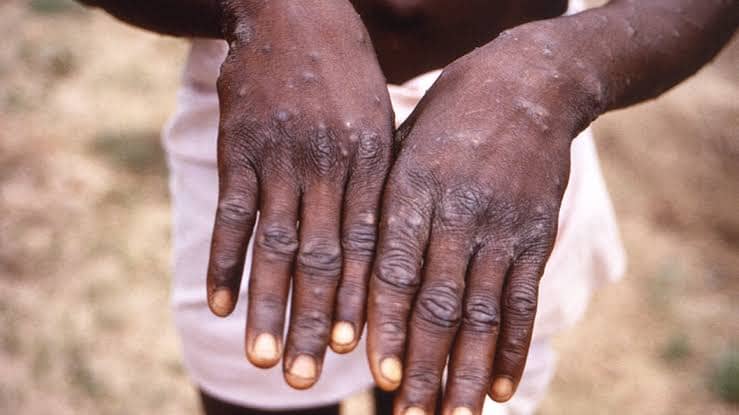mpox