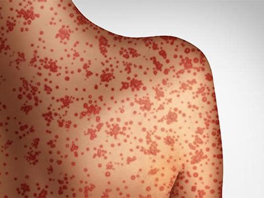 PAHO issues epidemiological alert amid continued measles transmission